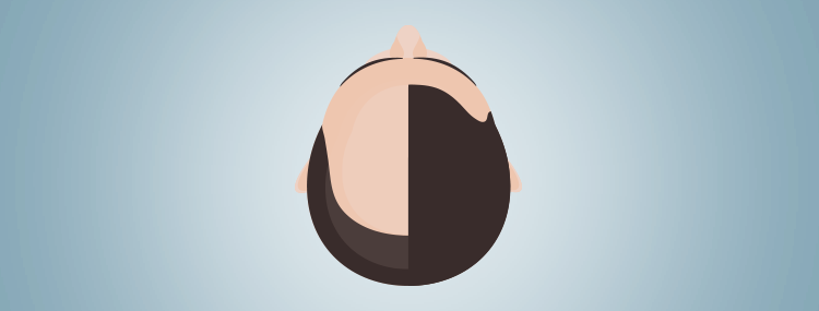 Hair transplant: 5 myths you need to know