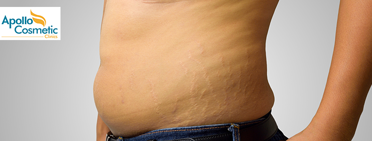 Stretch marks removal