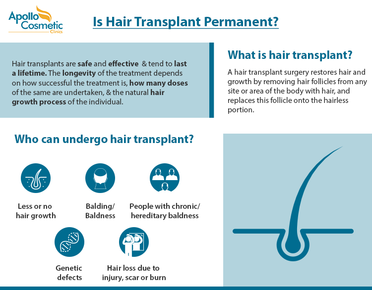 Hair Transplant - Does the surgery last a lifetime? - Apollo Cosmetics Hair Transplant - Does the surgery last a lifetime? - Apollo Cosmetics