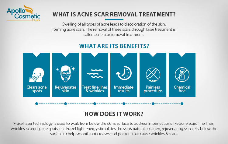 what is acne scar removal treatment - How it works and its benefits