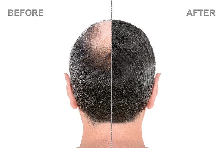 Hair Transplant in indore